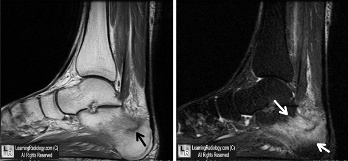 MRI calcaneal stress fracture